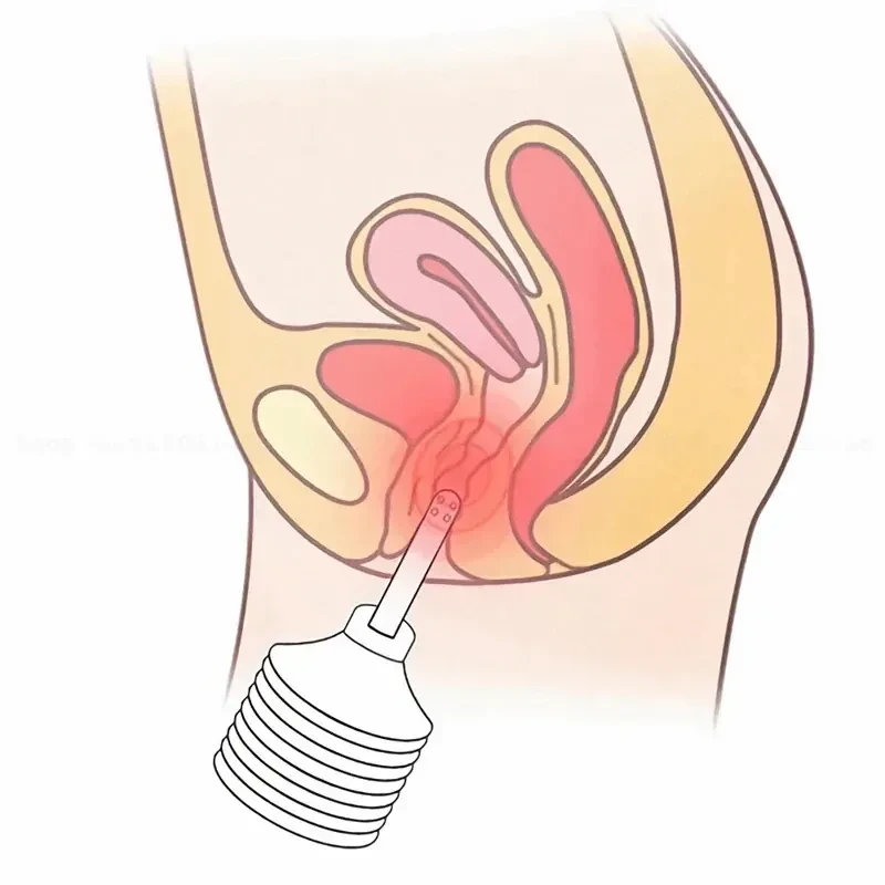 manual control disposable anal syringe